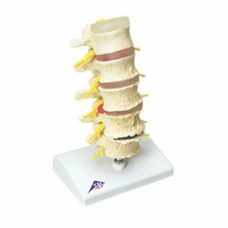 TOYS4.0 Anatomical Model Vertebrae Degeneration, Stages of Prolapsed Disc TO299767